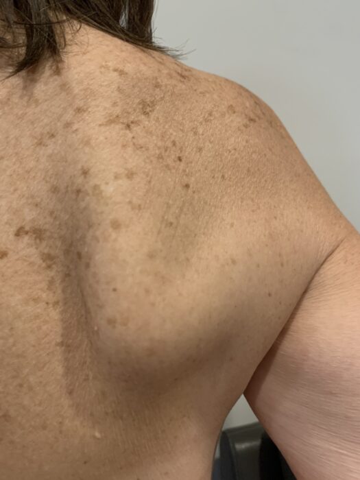 Scapula